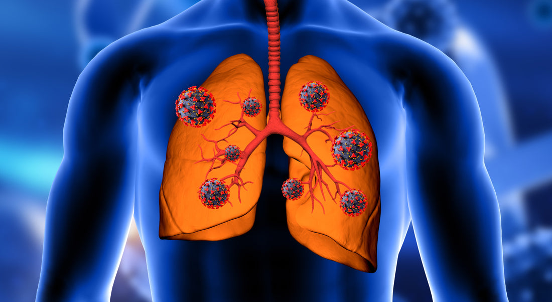 Lungs Cancer Smotect